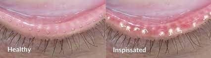 The picture on the left is healthy eyelid margins.  The one on the right with the little yellow bumps indicates clogged glands that need treatment. 