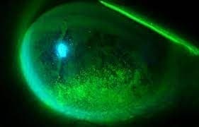 In this magnified picture of a dry cornea, the bright area indicates dryness and damaged cells. 