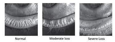 These infrared images show normal, moderate gland loss, and severe gland loss (from left to right). Gland loss occurs when the oil gland remains clogged and the oil gland just drops out and goes away. They do not return. Dryness will be much worse and much more difficult to treat at this level. This is not age related-. Pflugerville Vision Care has seen this in young patients who spend lots of time of their phone or on the computer. 