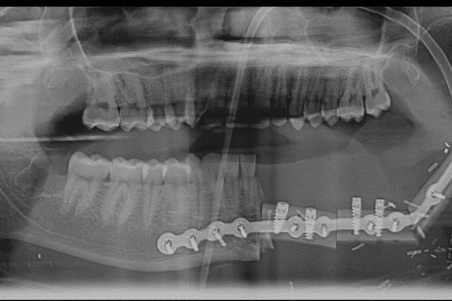 UTMB Health treats patients like family during ‘Jaw in a Day’ reconstructions