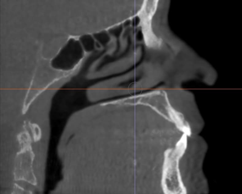"This is after six months with Spark Aligners," Dr. Buchanan said. "Notice the dark space that’s more open after six months of treatment. This creates better health and breathing for patients."
