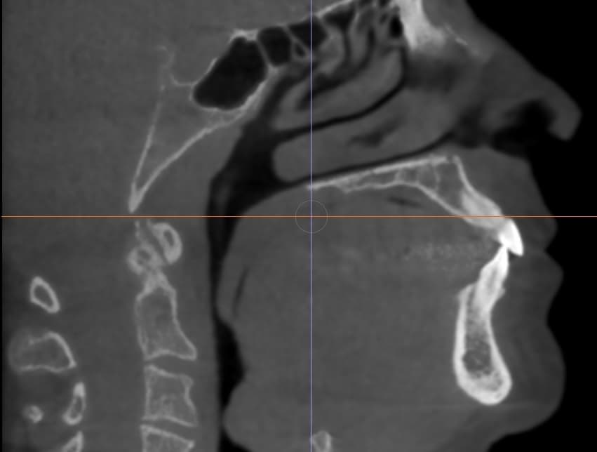 A photo of a patient before before Dr. Buchanan started orthodontic treatment with Spark Aligners. "Notice how narrow the dark space is meaning the airway is blocked off before treatment," Dr. Buchanan said.