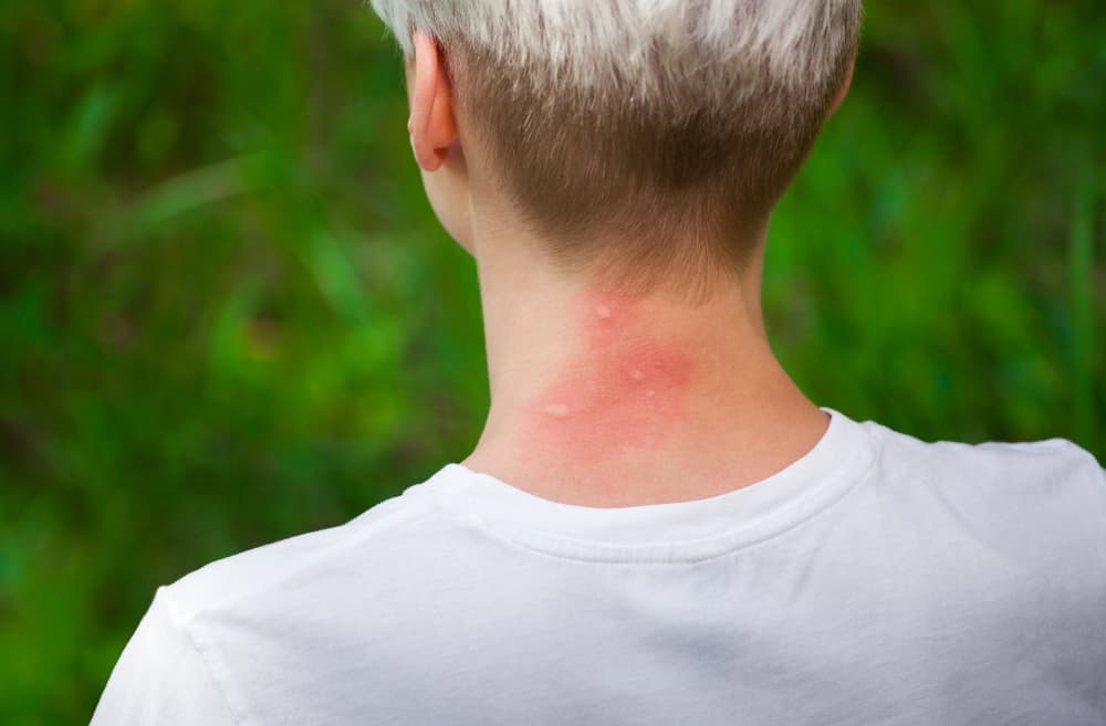 Dallas reports 2nd human case of West Nile virus