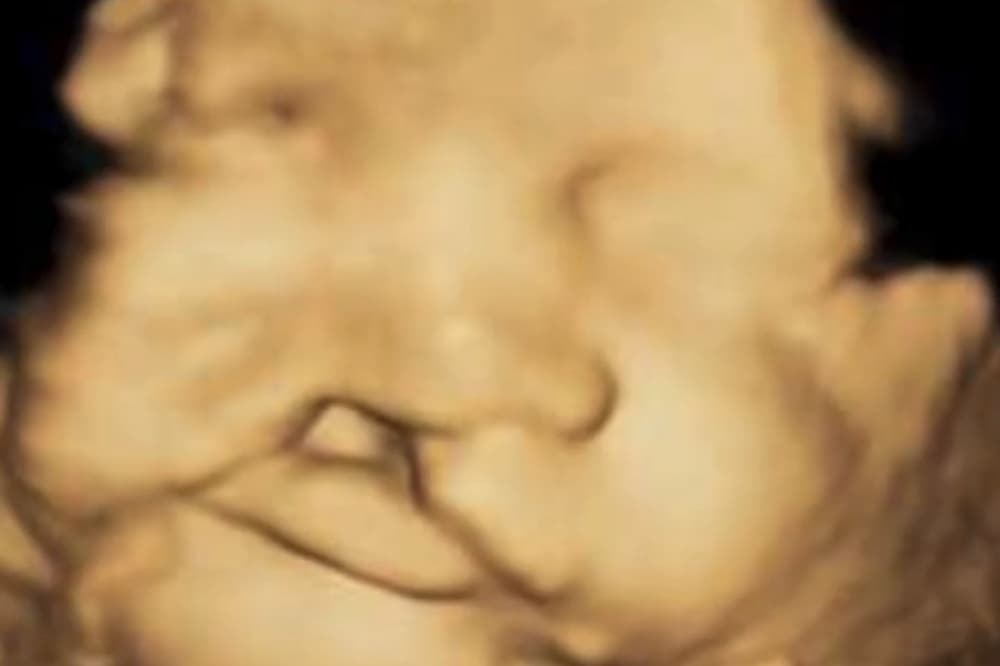 ultrasound of baby's face