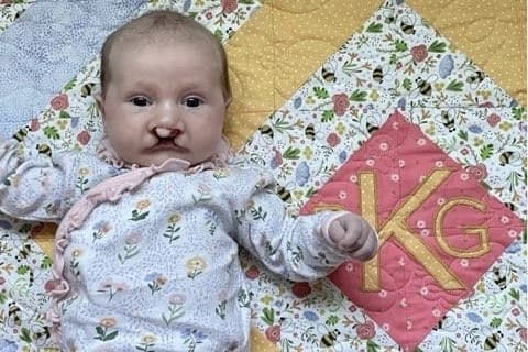 Manvel, Friendswood moms of babies with cleft palates find care, community