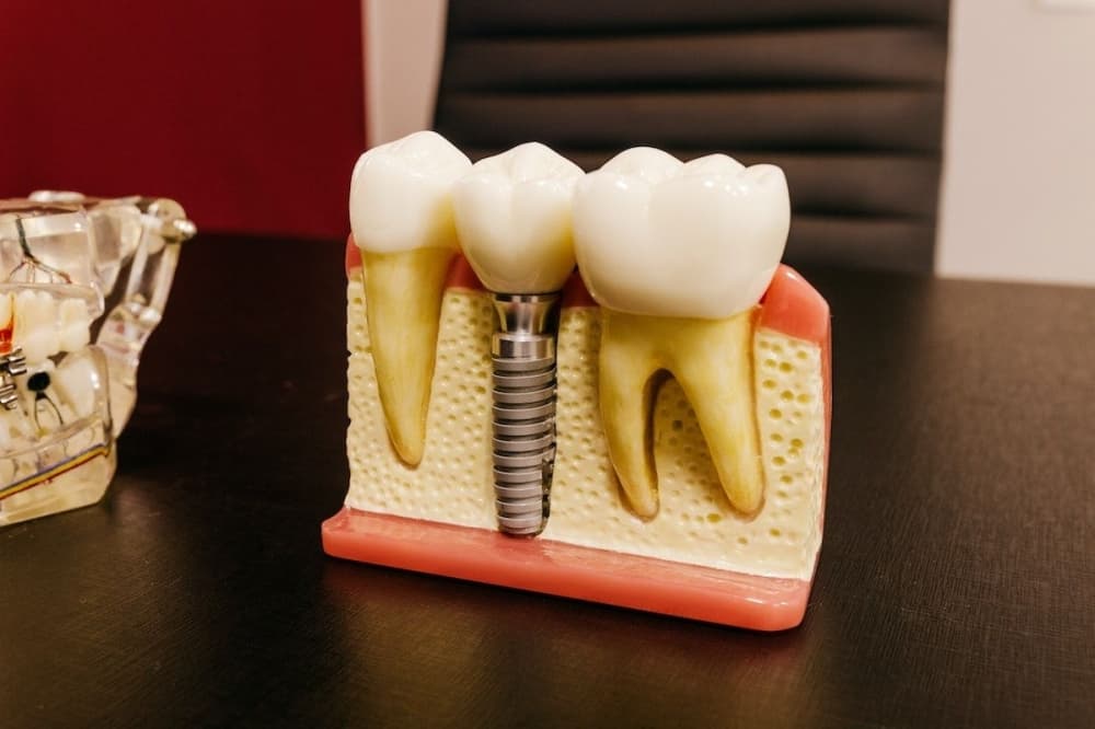 Renew Dental Implants offers restorative treatments in Webster