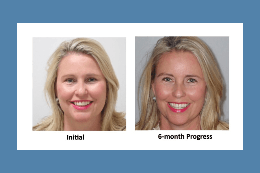 Dr. Jennifer Buchanan finds relief from sleep apnea with Spark Clear Aligners