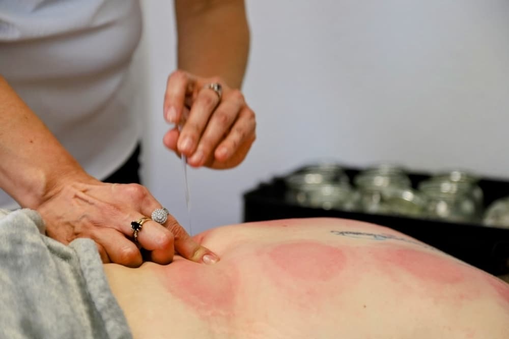 Dry needling is a technique that involves the insertion of a single acupuncture needle into a taut band of muscle, commonly referred to as a trigger point. (Courtesy The Point Acupuncture and Dry Needling Clinic)