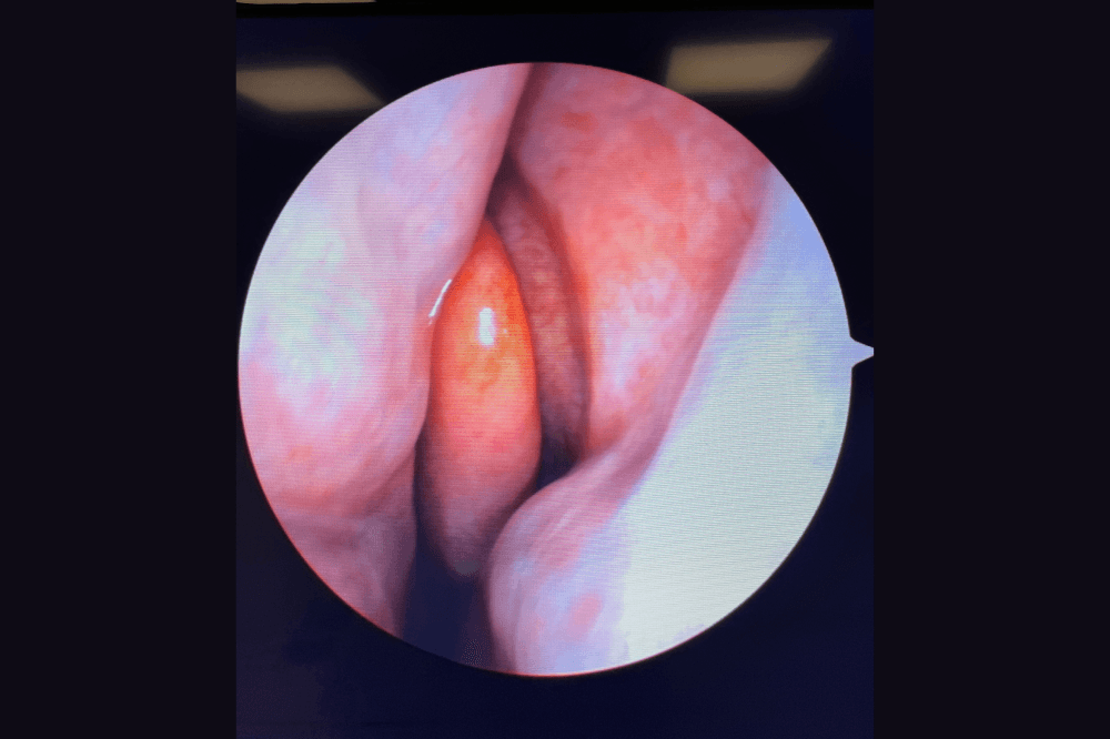Nasal polyp
