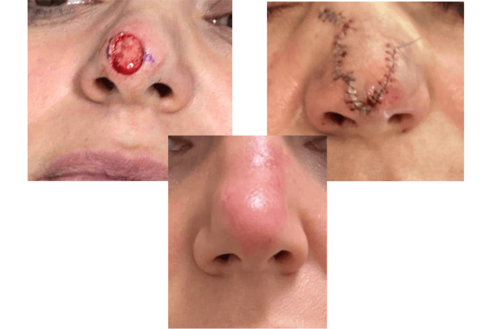 Mohs surgery repair