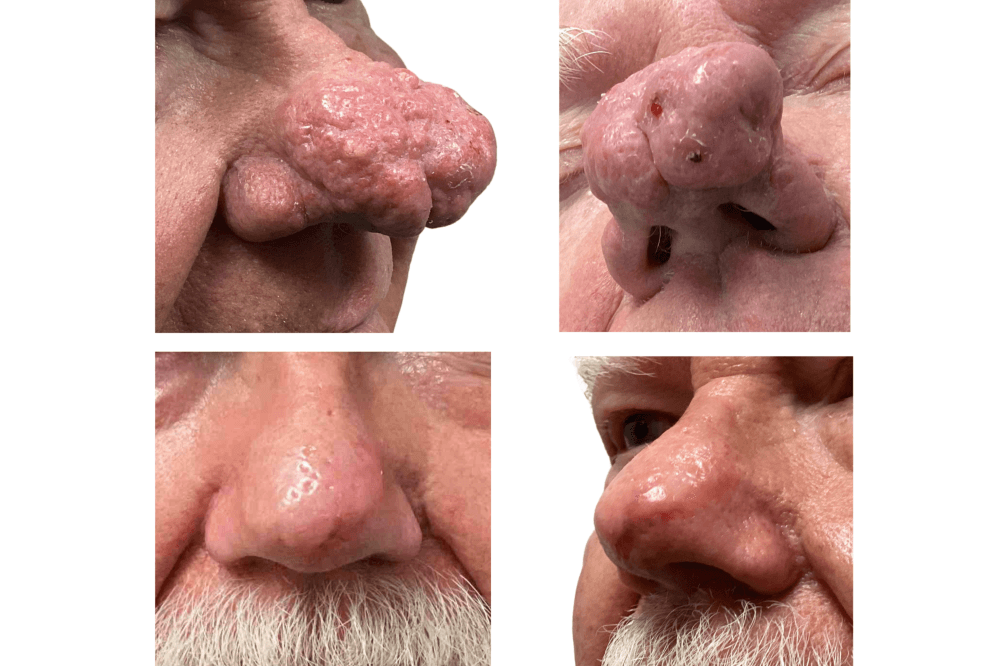 Rhinophyma results