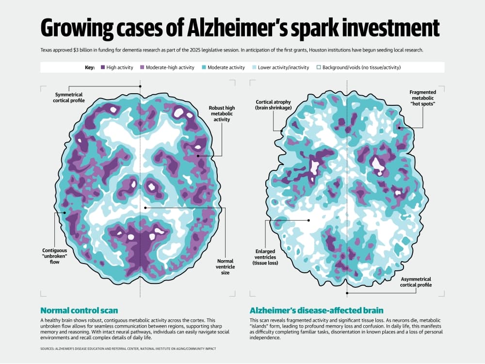 Health Care Guide: Growing cases of Alzheimer's spark investment