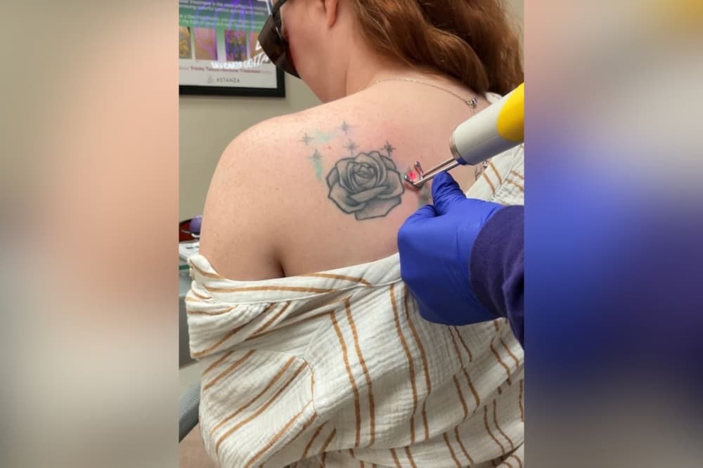 ZAP focuses on offering a personalized approach to tattoo removal. (Courtesy ZAP Tattoo Removal)