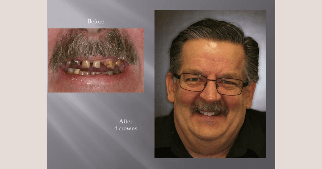 Before-and-after dental comparison showing a man's damaged teeth and his restored smile after 4 crowns.