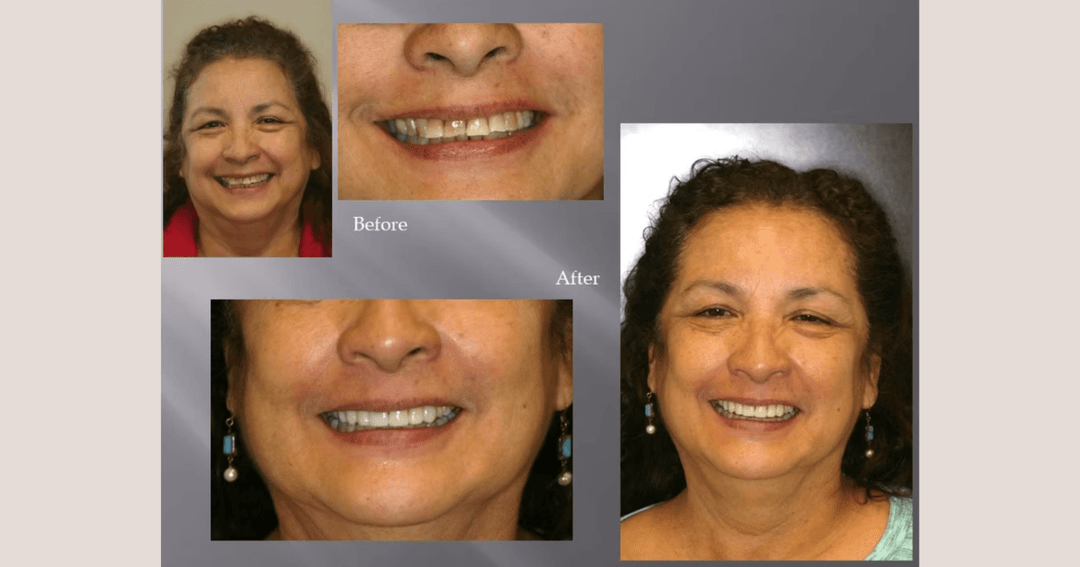 Before-and-after dental photos of a woman showing her smile improved after cosmetic treatment.
