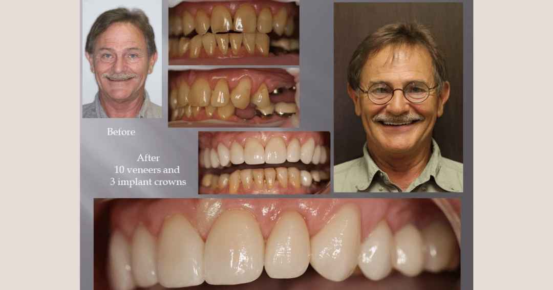 Before-and-after dental collage showing a man's smile improved with 10 veneers and 3 implant crowns.