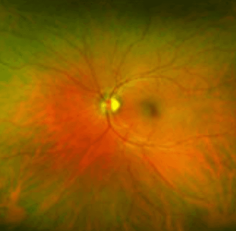 Retinal fundus image showing optic disc, blood vessels, and macula in orange and green tones.