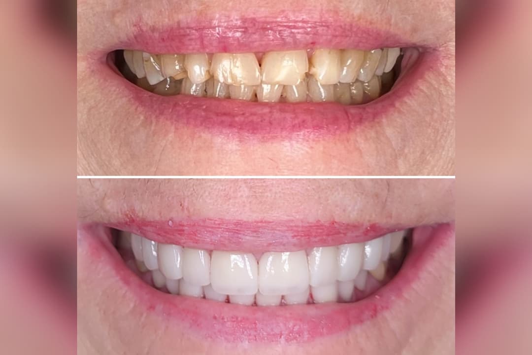 Before-and-after close-up of a smile showing yellowed, worn teeth above and whiter, even teeth below.