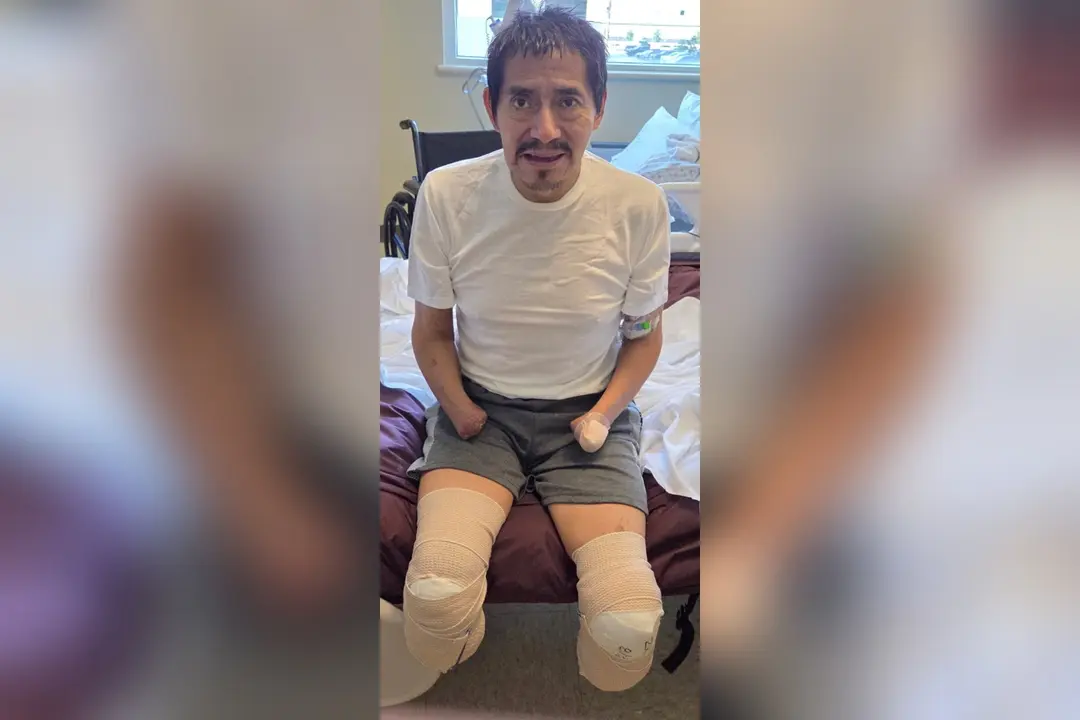 Man with amputated hands and bandaged leg stumps sits on a hospital bed near a wheelchair.