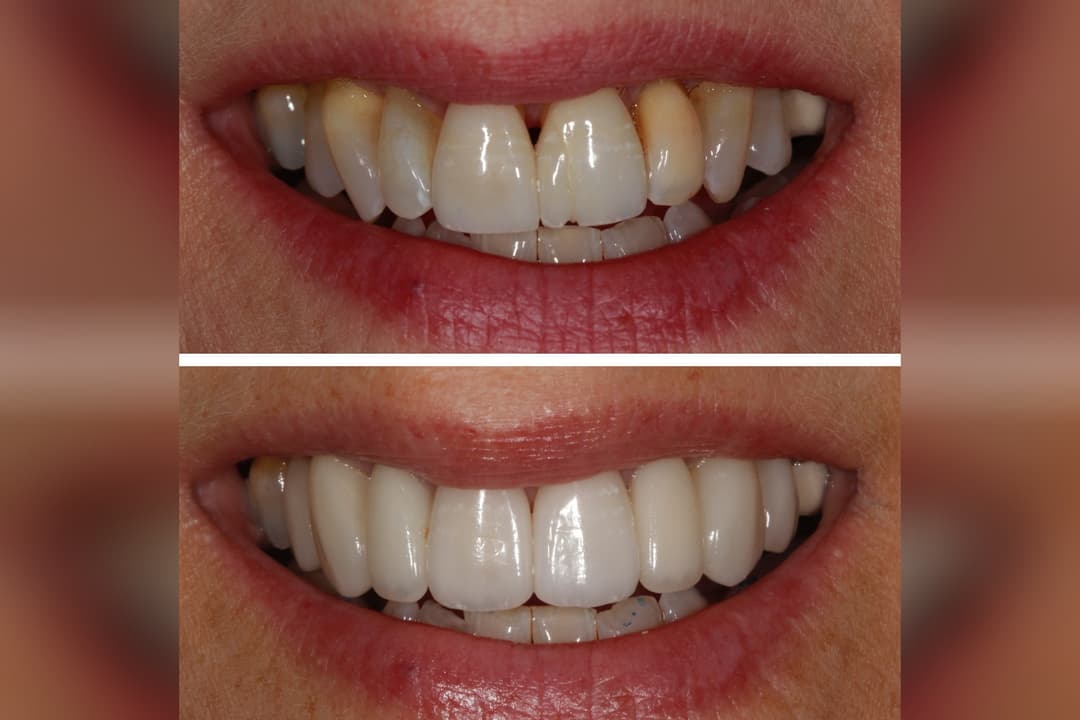 Before-and-after dental comparison showing uneven stained teeth above and straightened whiter teeth below.