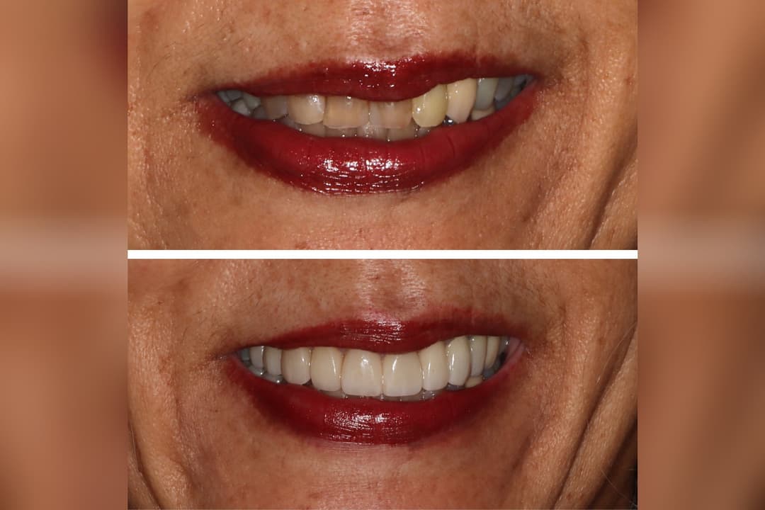Before-and-after dental comparison showing uneven teeth above and straight, even teeth below.