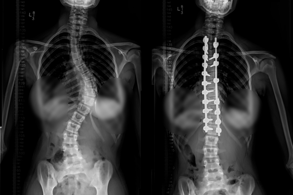 X-rays before and after Mock's surgery show her scoliosis has been corrected. (Courtesy Texas Children's Hospital)