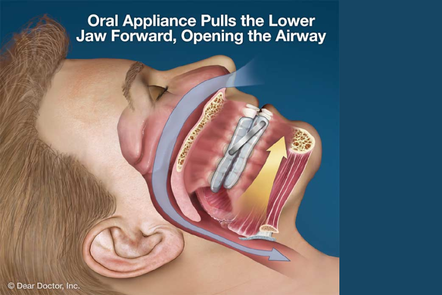 Diagram of how sleep apnea oral device works