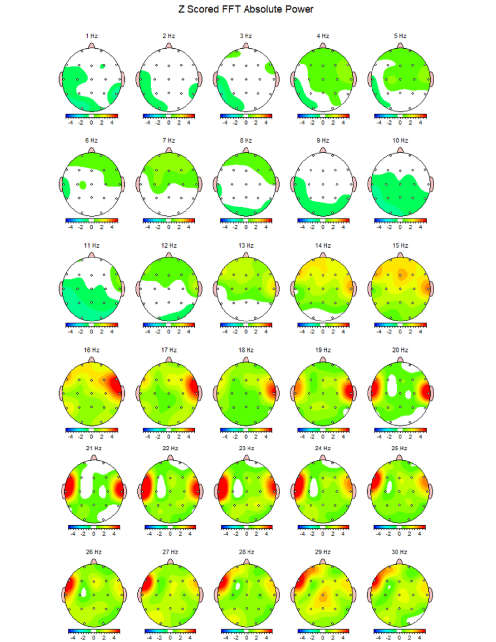 Brain maps provide a look at hyper and under active portions of the brain, which help guide counseling treatment plans Neurobehavioral Specialist Kylie Forgy said. (Courtesy Cypress Counseling & Wellness)